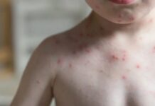 Confirma Secretaría de Salud primeros casos de sarampión en Michoacán